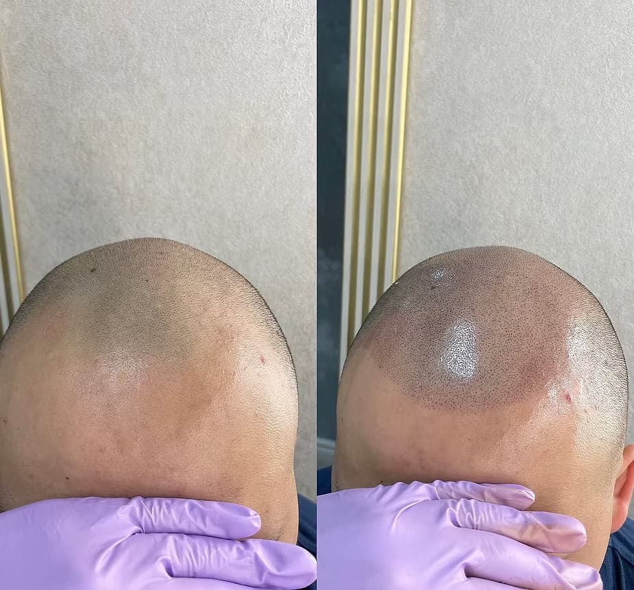 Trichopigmentierung Behandlung - Vorher und Nachher Vergleich